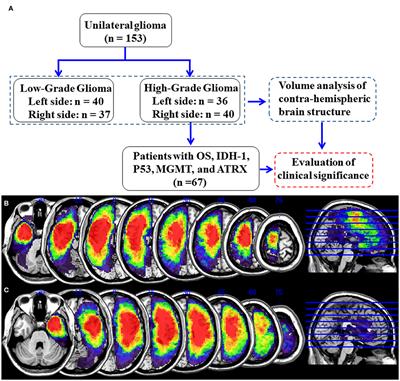 Contrahemispheric Cortex Predicts Survival and Molecular Markers in Patients With Unilateral <mark class="highlighted">High-Grade Gliomas</mark>